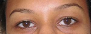IMG_1072-eyeliner-before-first-procedure